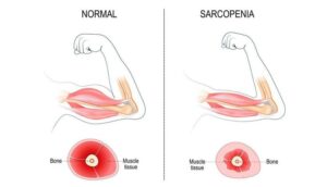 Sarcopenia in Seniors: How Physical Therapy Can Address Age-Related Muscle Loss Before It Limits Independence